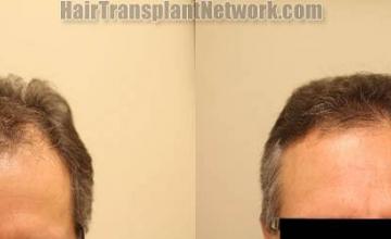 Hair restoration procedure before and after results