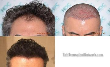 Before and after hair transplantation surgery