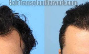 Front view - Before and after hair transplantation surgery