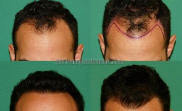 Front View - Before and after hair transplantation surgery