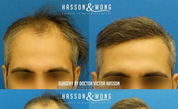 Front view - Before and after hair restoration procedure