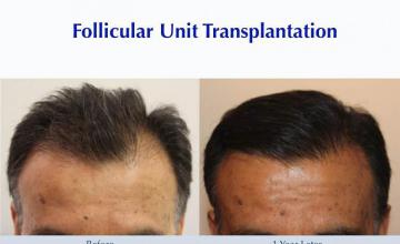 Before and after hair restoration procedure images