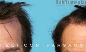 Before and after hair restoration procedure images