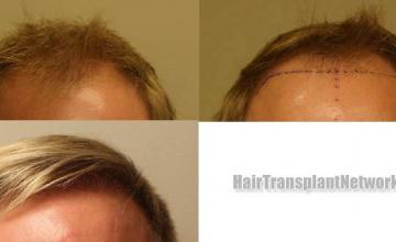 Front view - Before and after hair restoration procedure