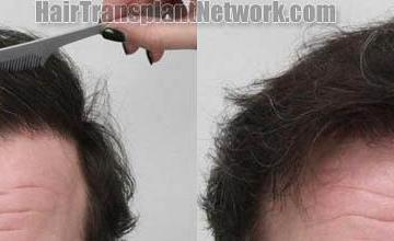 Hair restoration procedure before and after results