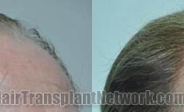 Hair transplantation surgery before and after photos