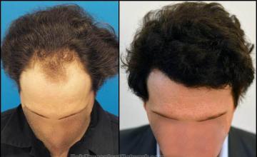 Hair transplantation surgery before and after photos