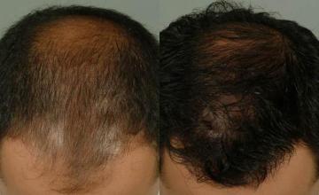 Hair restoration procedure before and after pictures