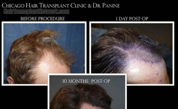 Hair transplantation surgery before and after pictures