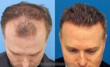 Top view before and after hair restoration results