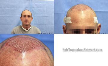 Hair restoration procedure before and after results