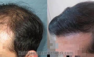 Hair transplantation surgery before and after photos