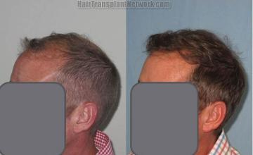 Hair transplantation surgery before and after pictures