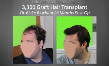 Hair restoration surgery before and after images