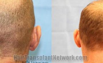 Hair restoration procedure before and after pictures