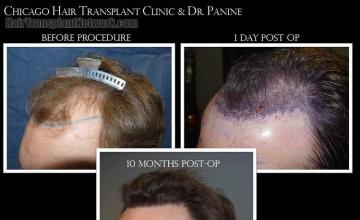 Hair restoration procedure before and after pictures