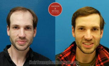 Hair restoration procedure before and after results