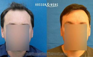 Hair restoration procedure before and after results