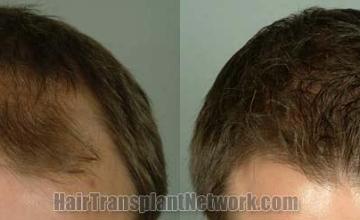 Tilt view before and after hair restoration results