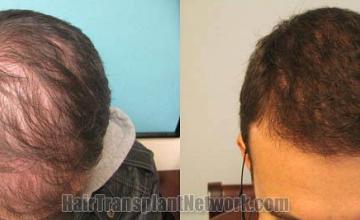 Top view before and after hair restoration results