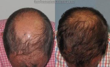 Hair transplantation surgery before and after photos