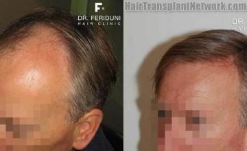 Surgical hair transplantation result photographs