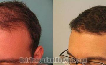 urgical hair transplantation result photographs