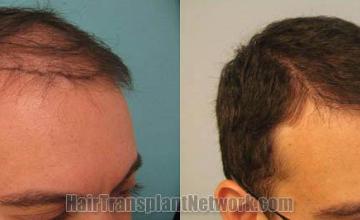 Before and after surgical hair restoration images