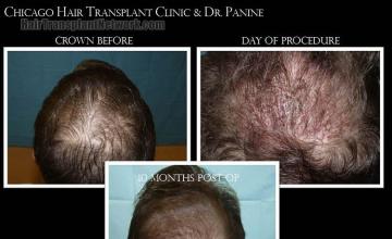 Hair restoration procedure before and after results