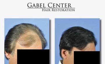 Hair transplantation surgery before and after images