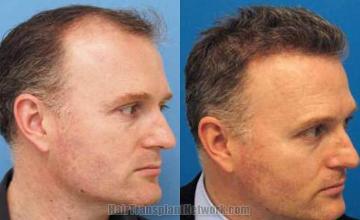 Hair restoration procedure before and after results