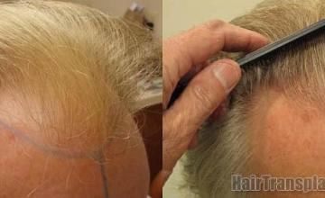 Hair restoration procedure before and after pictures