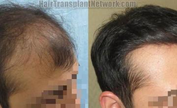 Hair restoration procedure before and after pictures