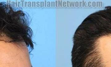 Hair transplantation surgery before and after images