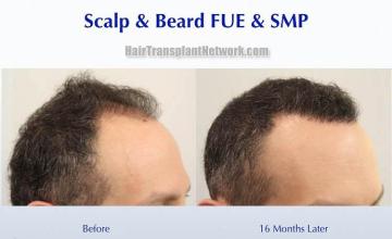 Hair restoration procedure before and after results