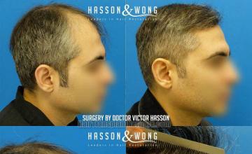 Hair restoration procedure before and after result images