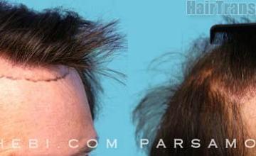 Hair restoration procedure before and after result images