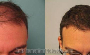 Hair transplant surgery before and after photos