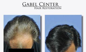 Hair transplantation surgery before and after photos