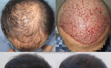 Hair transplantation surgery before and after pictures