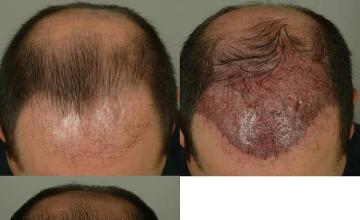 Hair restoration procedure before and after pictures