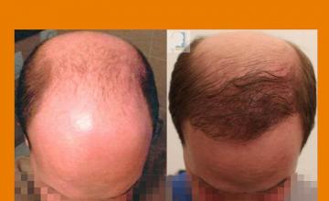 Before and after hair transplantation surgery