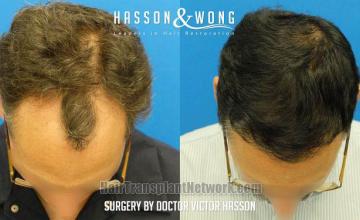 Before and after hair transplant procedure images