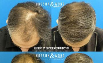 Before and after hair restoration procedure images