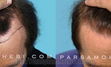 Top view - Before and after hair restoration procedure