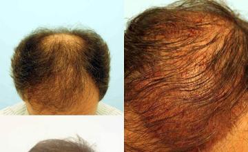 Before and after hair restoration procedure images