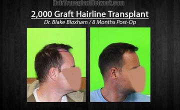 Hair restoration procedure before and after results photographs