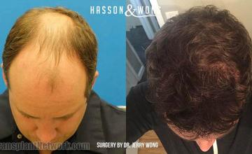 Hair restoration procedure before and after pictures