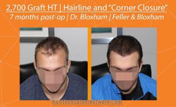 Hair restoration procedure before and after results