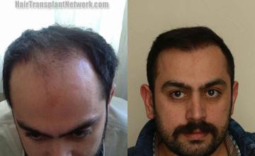 Hair restoration surgery before and after images